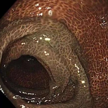 女子便秘10年，肠道变黑，被迫切掉30厘米！竟因这类网红产品换着吃，医生提醒→