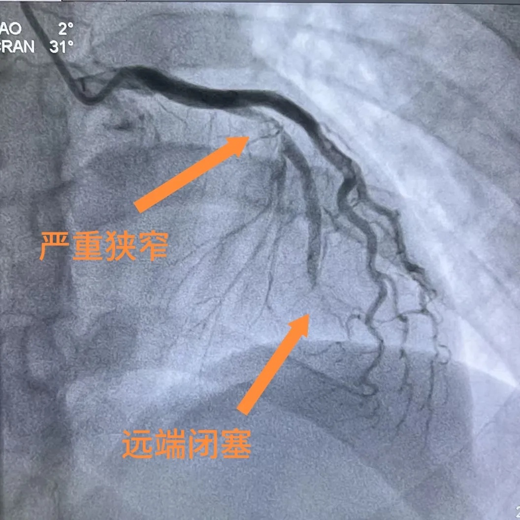濒死感!浙江33岁小伙梦中因剧痛惊醒,胸口被巨石压住 濒死感!浙江33岁小伙梦中因剧痛惊醒,胸口被巨石压住
