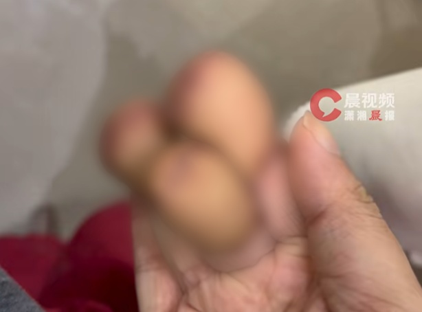 机械“咬”手，女子右手三指不保！危险瞬间往往藏在最熟悉的环节中