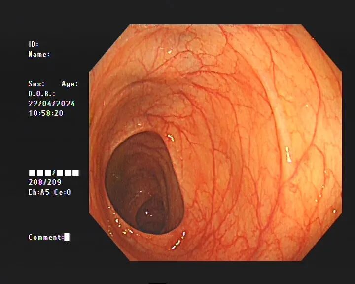女子便秘10年，肠道变黑，被迫切掉30厘米！竟因这类网红产品换着吃，医生提醒→