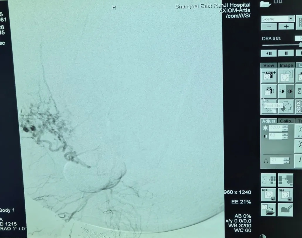 45岁女子肚子疯狂膨胀，比怀孕还夸张！以为是中年发福，结果取出56斤重的“超级巨瘤”