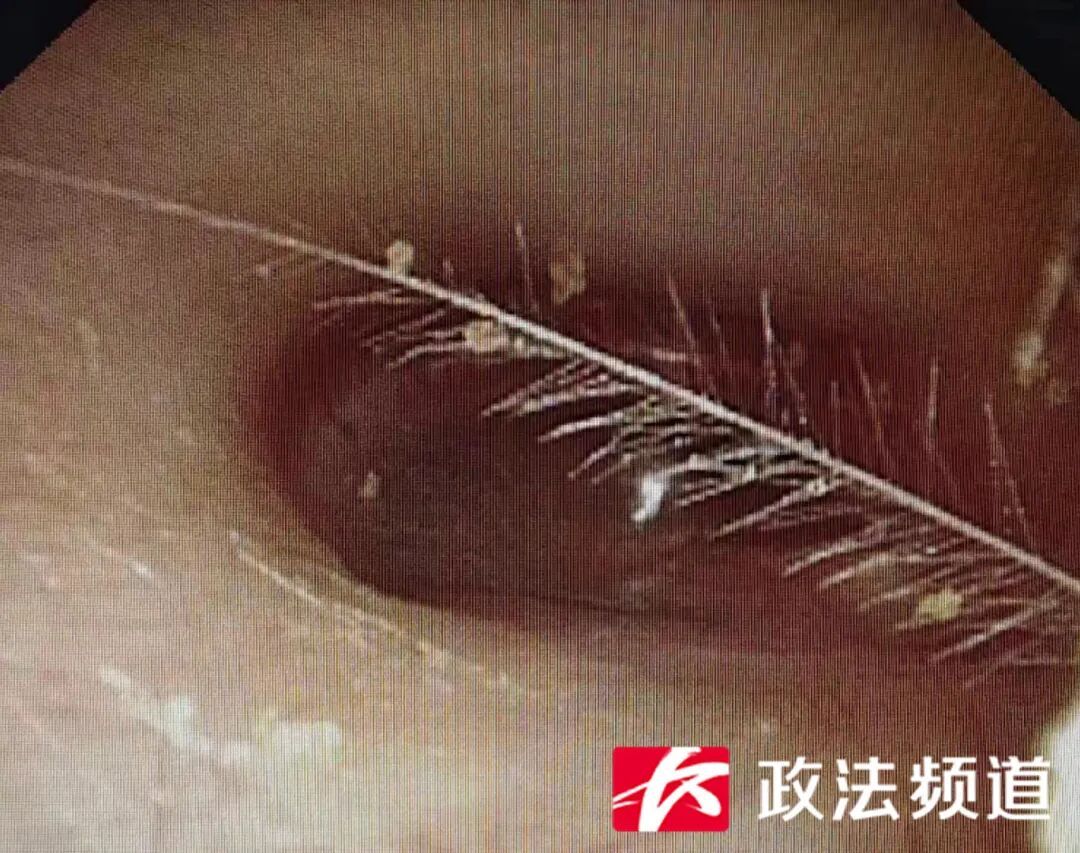 四岁女童耳朵发炎疼痛,“元凶” 竟是每天穿的…… 四岁女童耳朵发炎疼痛,“元凶” 竟是每天穿的……