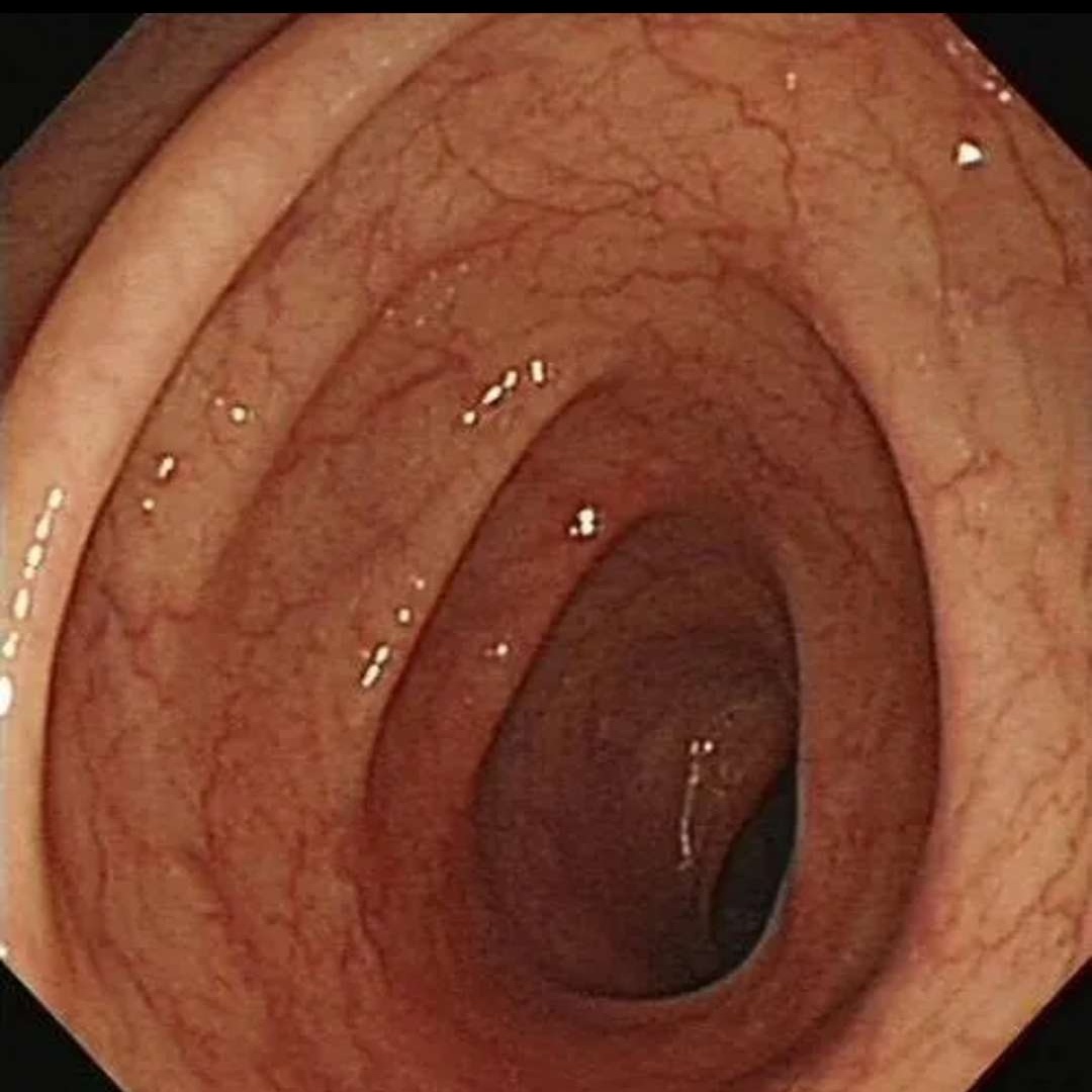 女子便秘10年，肠道变黑，被迫切掉30厘米！竟因这类网红产品换着吃，医生提醒→