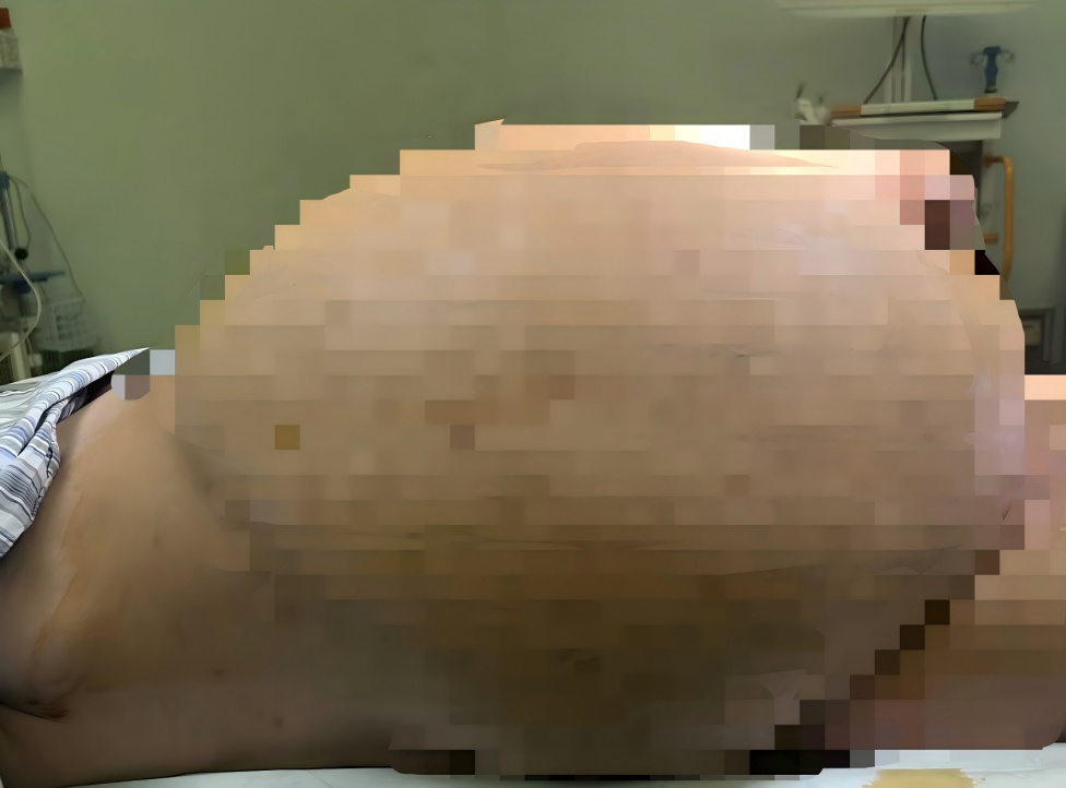 45岁女子本以为中年发福，没想到竟从腹部剖出56斤巨大肿瘤…这种情况千万别忍