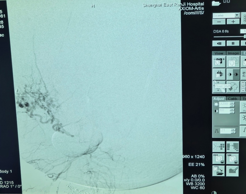 45岁女子本以为中年发福，没想到竟从腹部剖出56斤巨大肿瘤…这种情况千万别忍