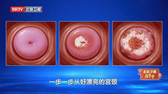 80%女性都躲不过的病毒，反复感染会癌变，教你2招，把风险挡在门外