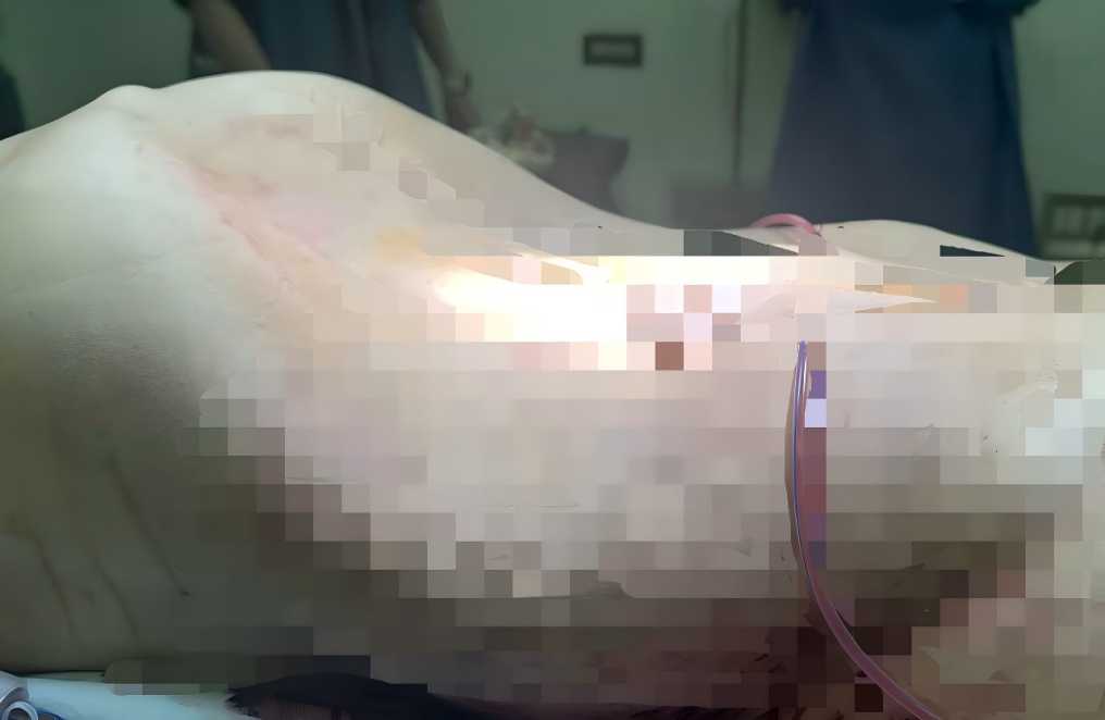 45岁女子本以为中年发福，没想到竟从腹部剖出56斤巨大肿瘤…这种情况千万别忍