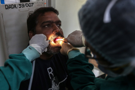 芬兰研究发现龋齿可能增加罹患痴呆症风险