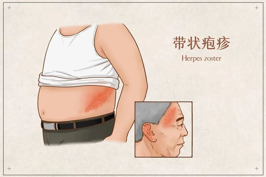 剧烈疼痛！这种病进入高发期，如何预防？