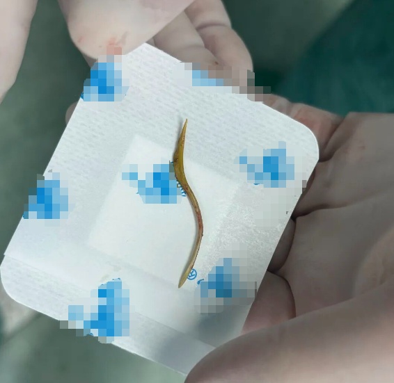 吃鱼最怕的事发生了!福建一39岁男子被尖锐鱼刺戳破肠子!医生提醒→ 吃鱼最怕的事发生了!福建一39岁男子被尖锐鱼刺戳破肠子!医生提醒→