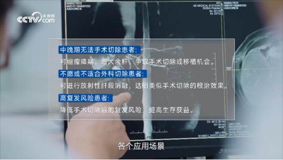 直击病灶，重燃生机 钇-90为肝癌患者带来新希望