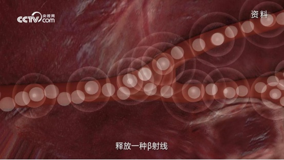 直击病灶，重燃生机 钇-90为肝癌患者带来新希望
