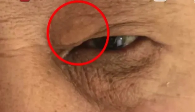 警惕!脸上出现上皮脂肪瘤和耳垂褶皱马上就医!医生仅看了男子一眼,发现猝死先兆 警惕!脸上出现上皮脂肪瘤和耳垂褶皱马上就医!医生仅看了男子一眼,发现猝死先兆
