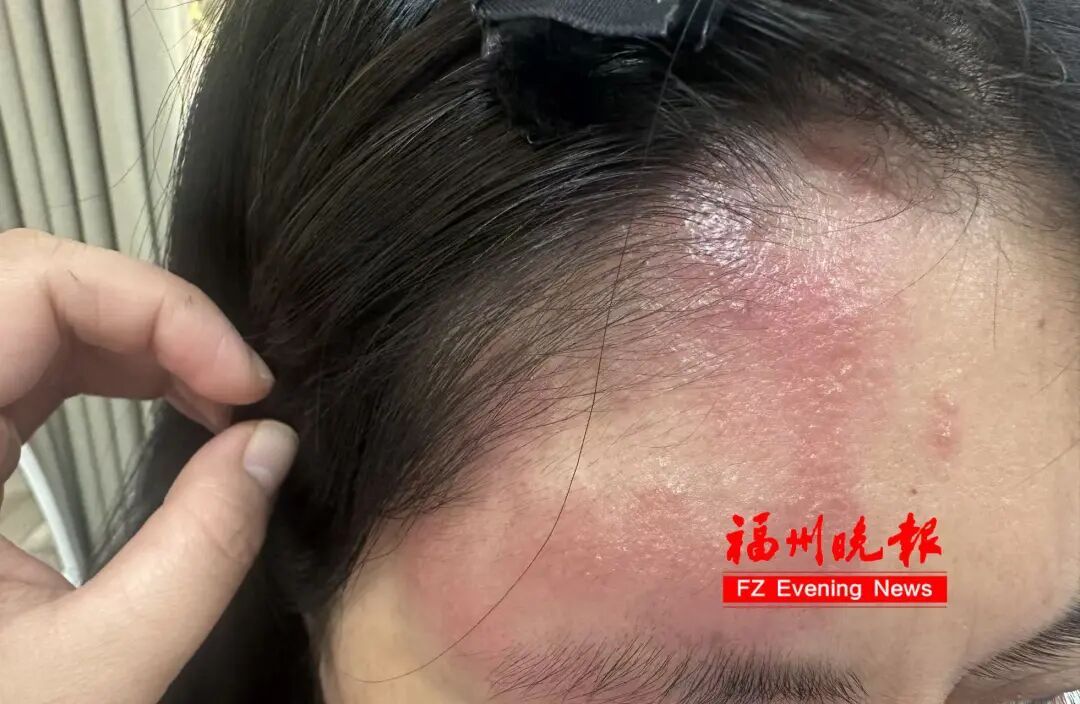 23岁小伙患带状疱疹，父亲涂抹“符水”试图治疗！耽误最佳治疗期……