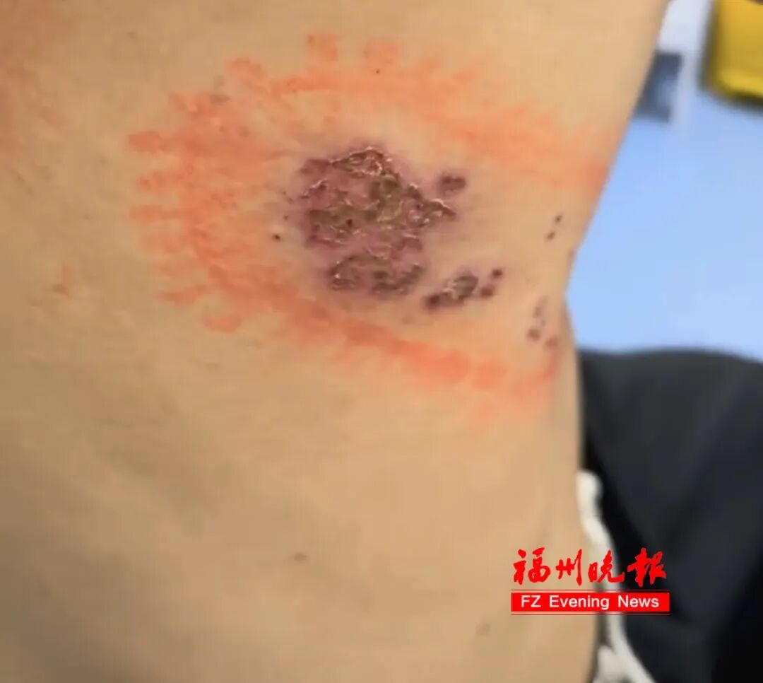 23岁小伙患带状疱疹，父亲涂抹“符水”试图治疗！耽误最佳治疗期……