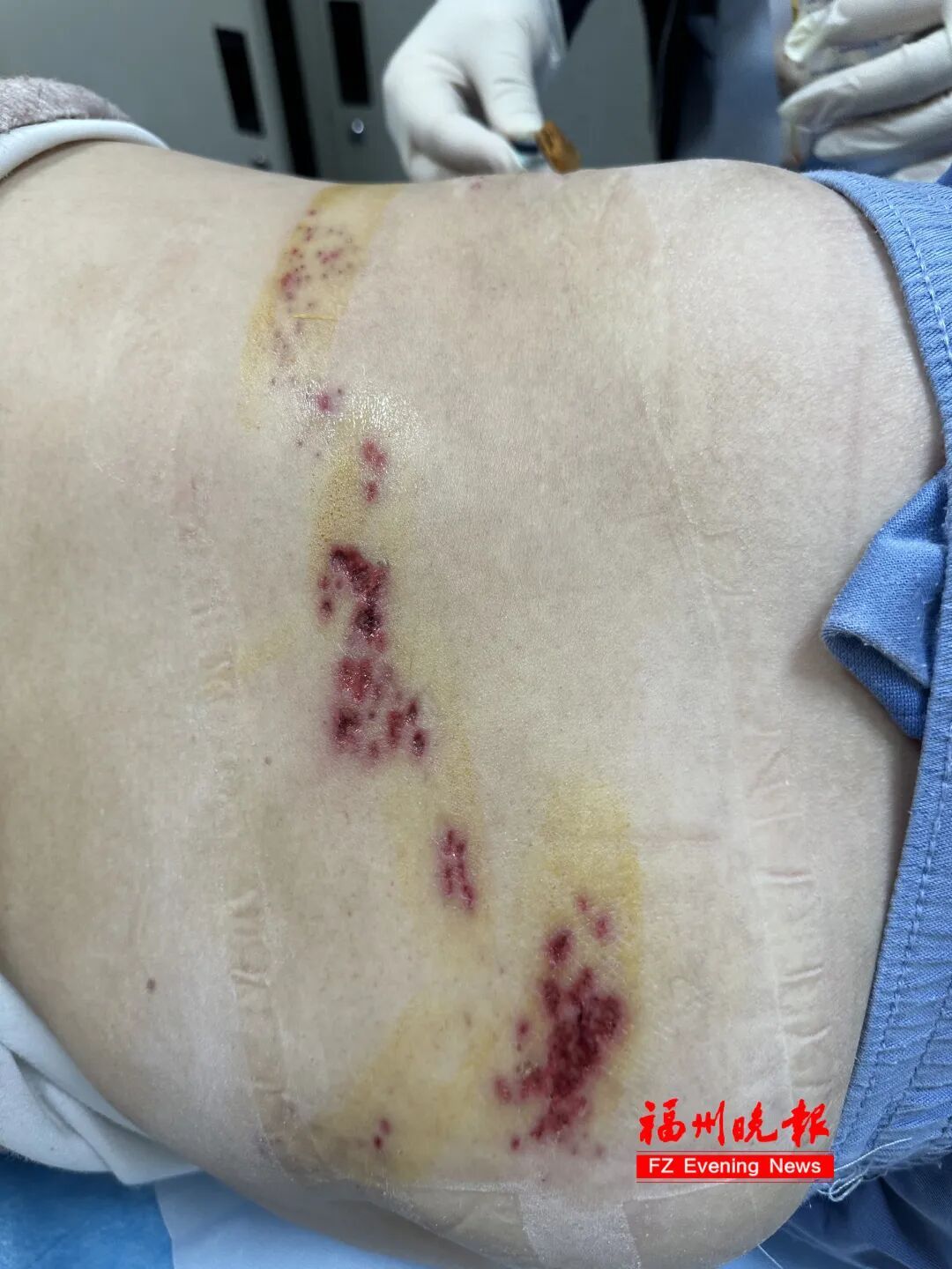 23岁小伙患带状疱疹，父亲涂抹“符水”试图治疗！耽误最佳治疗期……