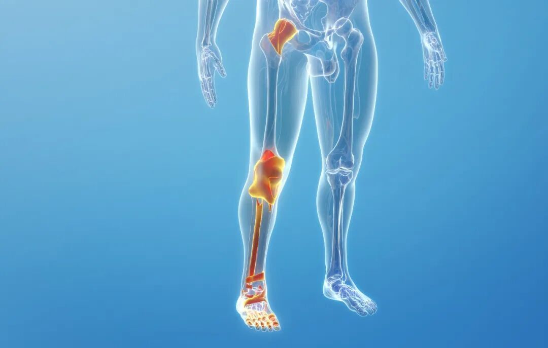 腿疼别总盯着“骨头”，可能是血管在报警