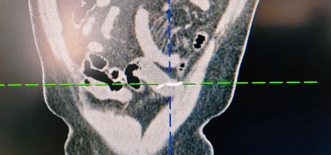 吃鱼最怕的事发生了!福建一39岁男子被尖锐鱼刺戳破肠子!医生提醒→ 吃鱼最怕的事发生了!福建一39岁男子被尖锐鱼刺戳破肠子!医生提醒→