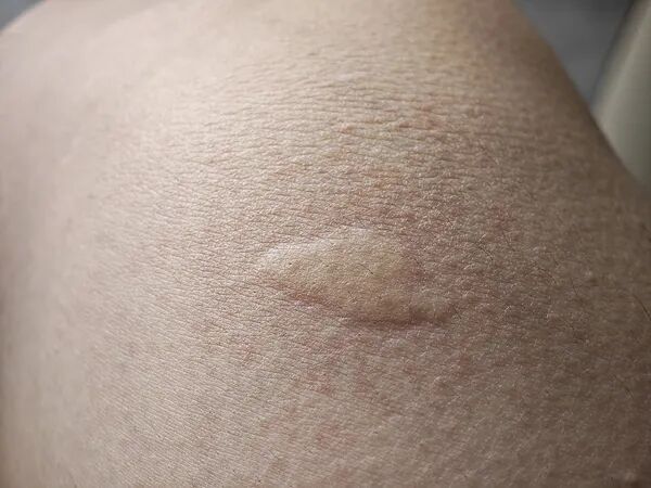 今年蚊子"史诗级加强"？上海人瑟瑟发抖…中疾控提醒