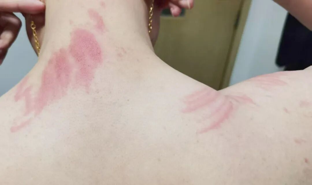 春游踏青回来，身上长满“鞭痕”！医生：不是过敏