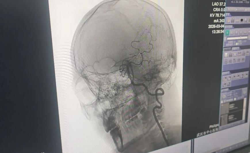 33岁男子按摩后突发脑梗！医生：脖子有2个“致命点 ”千万别乱按