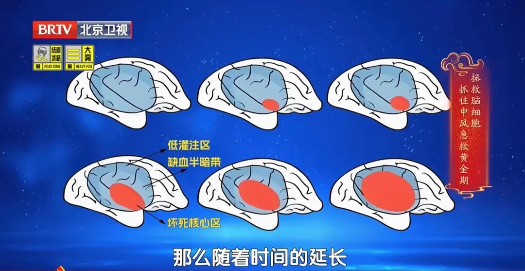 迟1小时，大脑老化3.6年，脑细胞死百万个！新版“中风120”口诀，快收藏能救命