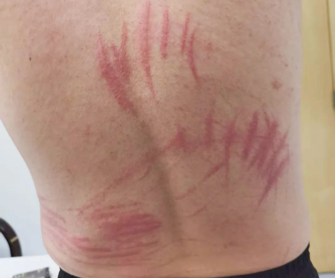 一口烤蘑菇惹来满身“鞭痕”!春季尝鲜需谨慎 一口烤蘑菇惹来满身“鞭痕”!春季尝鲜需谨慎