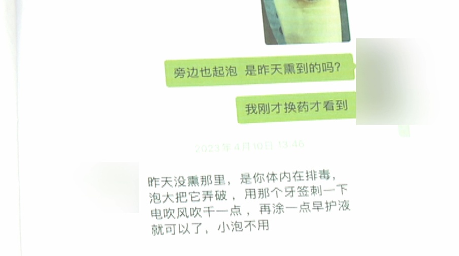 养生变“伤身”！厦门一女子艾灸理疗烫伤小腿，花了一万多元才治好，医药费该谁出？