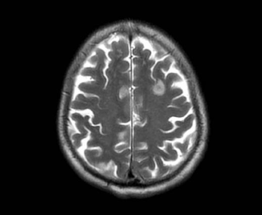 没有伤口、没碰脏物，它却“钻”进大脑和肺…差点要了他的命！