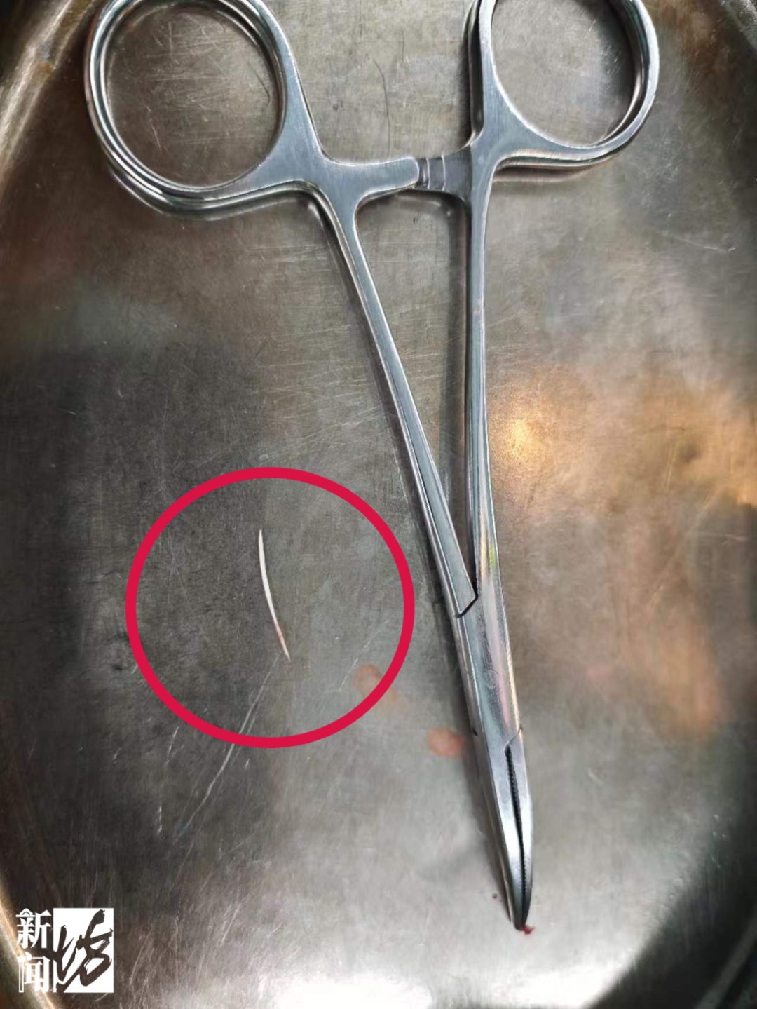 上海瑞金医院接诊！女子一口下去险丧命！穿透食管，距颈动脉仅3毫米…