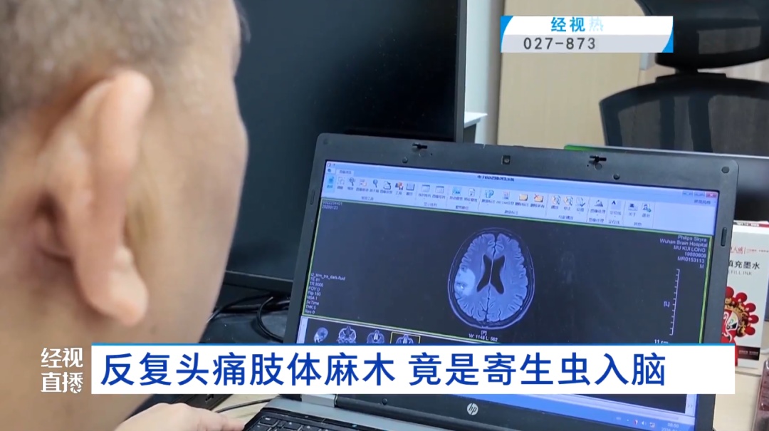 武汉33岁宠物店老板反复头痛肢体麻木，竟是寄生虫入脑！医生提醒