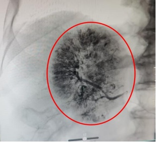 七旬患肝癌奶奶跳广场舞太激烈导致肿瘤破裂，专家提醒：每次跳30-60分钟为佳