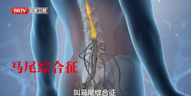 伤腰最狠的4个动作，你可能每天都在做，严重可致瘫痪，越早纠正越好