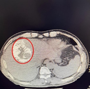 七旬患肝癌奶奶跳广场舞太激烈导致肿瘤破裂，专家提醒：每次跳30-60分钟为佳
