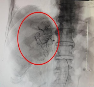 七旬患肝癌奶奶跳广场舞太激烈导致肿瘤破裂，专家提醒：每次跳30-60分钟为佳