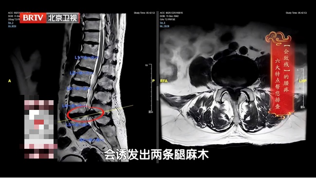 伤腰最狠的4个动作，你可能每天都在做，严重可致瘫痪，越早纠正越好