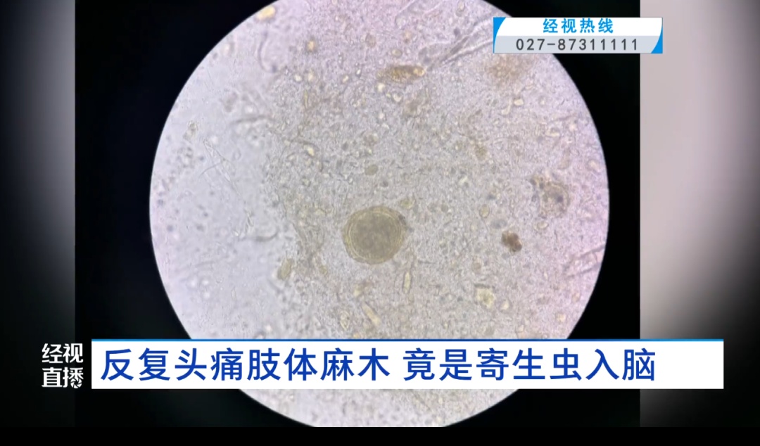 武汉33岁宠物店老板反复头痛肢体麻木，竟是寄生虫入脑！医生提醒