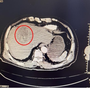 七旬患肝癌奶奶跳广场舞太激烈导致肿瘤破裂，专家提醒：每次跳30-60分钟为佳