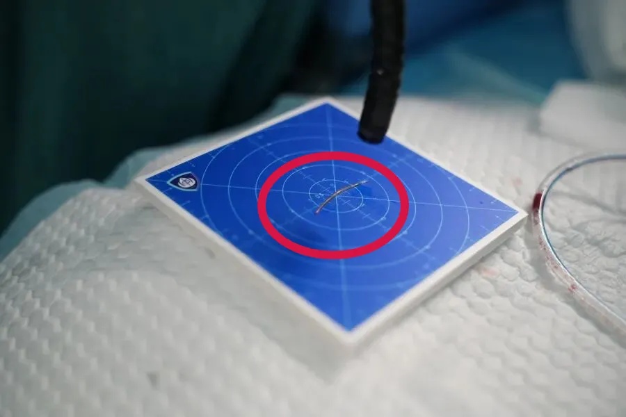 上海瑞金医院接诊！女子一口下去险丧命！穿透食管，距颈动脉仅3毫米…