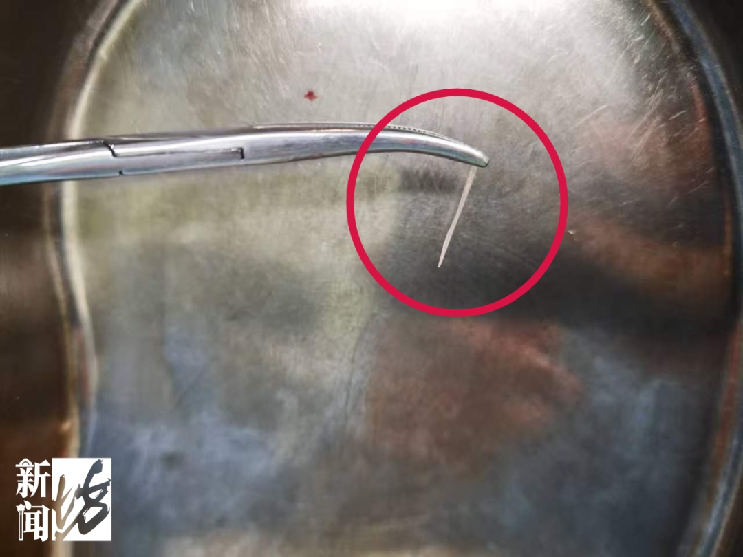 女子一口下去险丧命，穿透食管，距颈动脉仅3毫米……医生提醒误吞鱼刺别用“土方法”