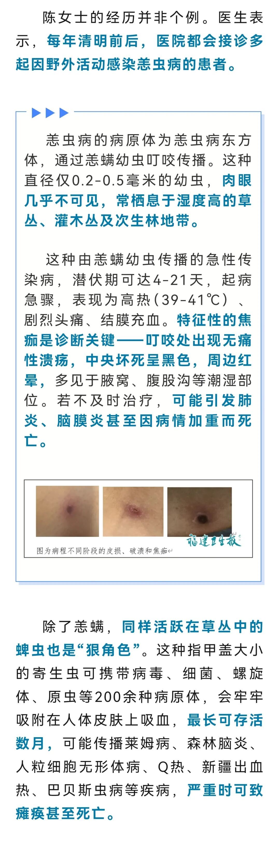 女子反复发烧一周，确诊恙虫病！福州医生：春天踏青需注意，严重可致命