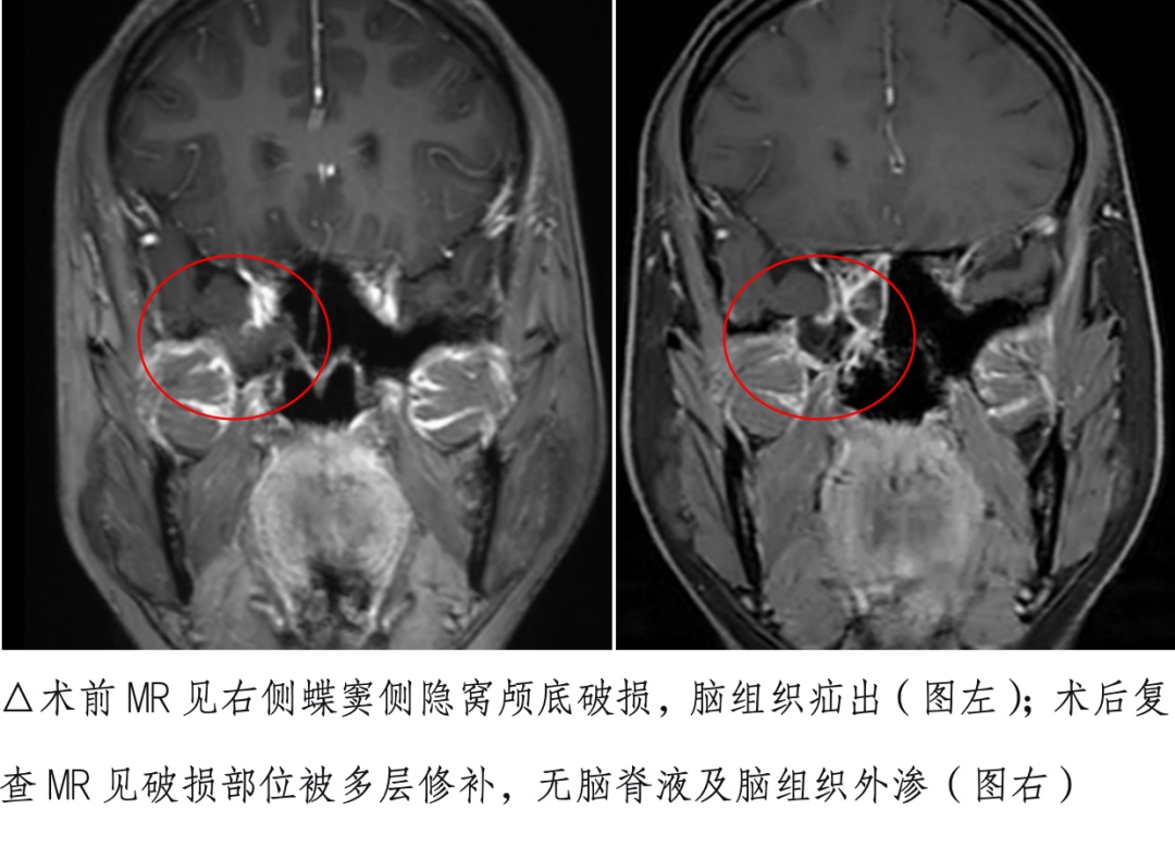 女子反复流鼻涕，鼻涕透明清亮，一查居然是脑子“漏了”……