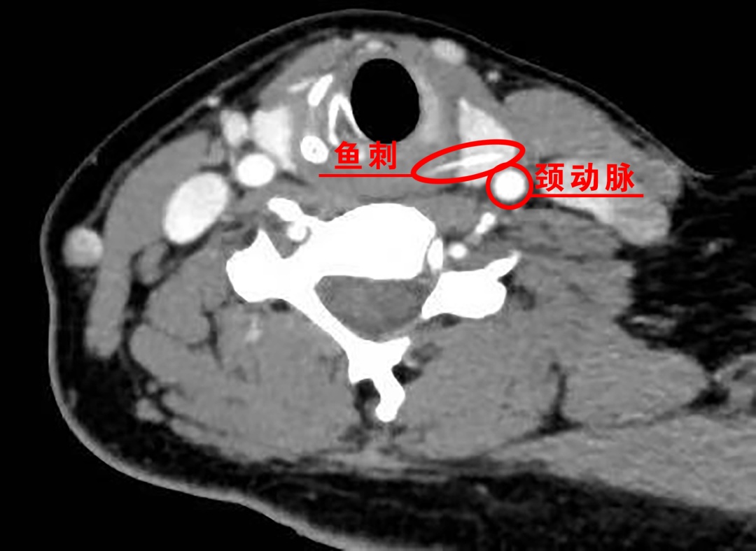 女子一口下去险丧命，穿透食管，距颈动脉仅3毫米……医生提醒误吞鱼刺别用“土方法”