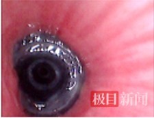 9岁男孩反复肺炎，“失踪”的笔帽在支气管里找到了