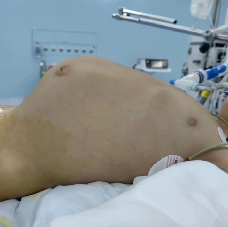 福建2岁娃肚子鼓成皮球，父母以为是孩子长得胖，没想到是肿瘤晚期，医生提醒