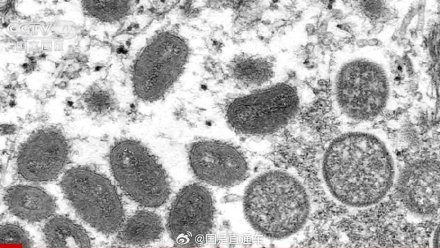 刚果金宣布猴痘疫情结束