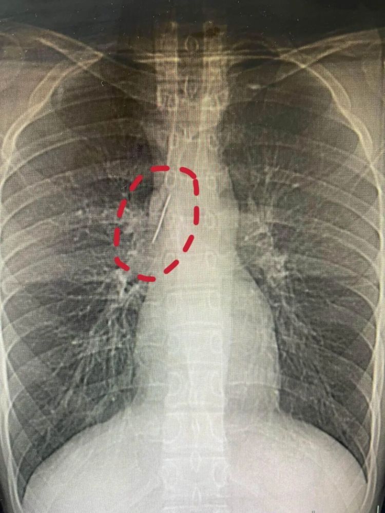 17岁在杭小伙胸腔藏了一枚5cm长的缝衣针，刺入肺组织，紧贴大血管竟毫发无伤！