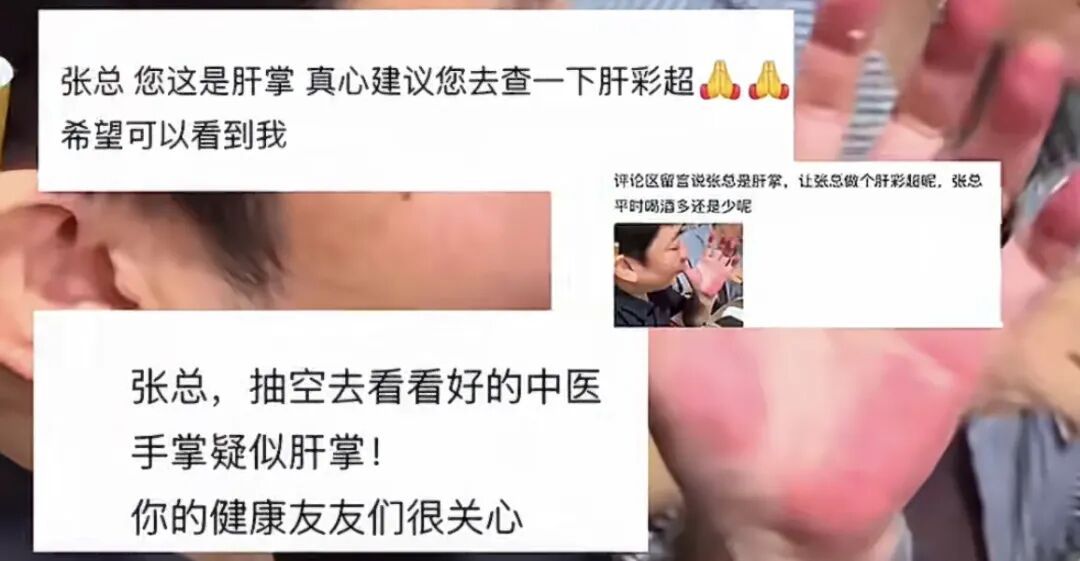 张雪因手掌太红被网友提醒及时就医!此前回应:肝没问题!医生提醒→ 张雪因手掌太红被网友提醒及时就医!此前回应:肝没问题!医生提醒→