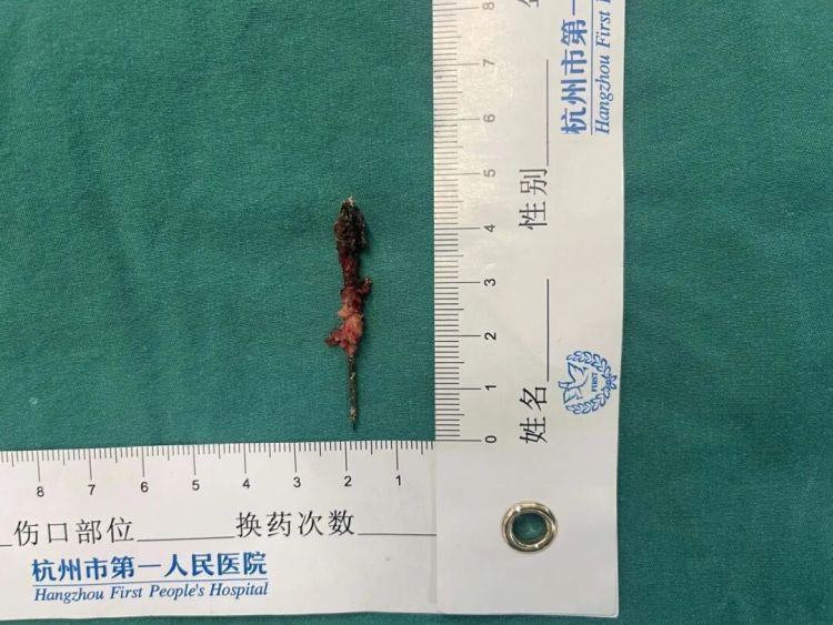 17岁在杭小伙胸腔藏了一枚5cm长的缝衣针，刺入肺组织，紧贴大血管竟毫发无伤！