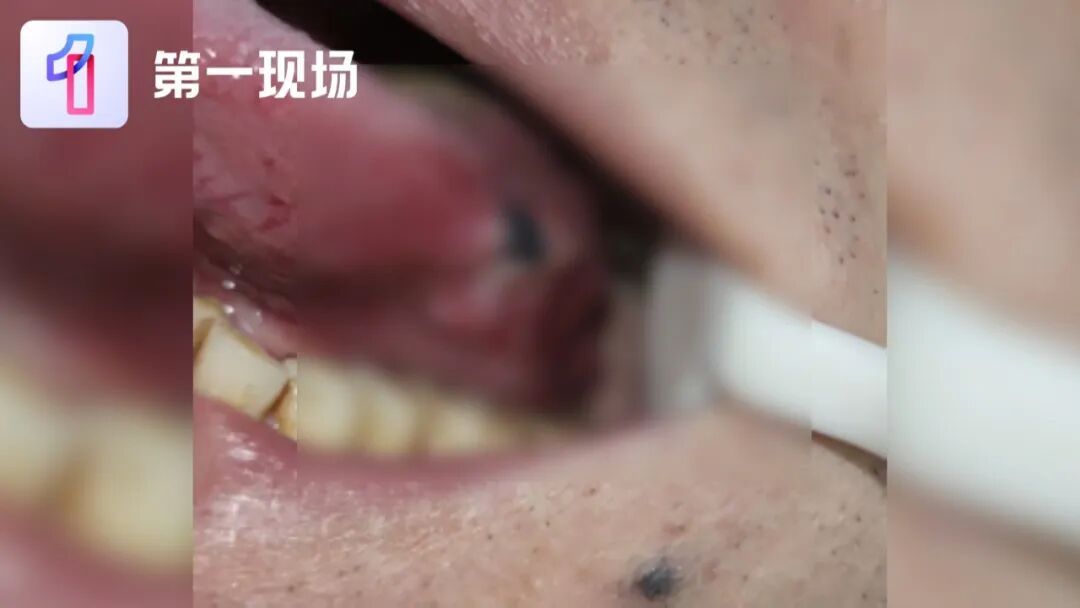 以为“上火了”,结果是癌!男子被切除半根舌头…医生紧急提醒 以为“上火了”,结果是癌!男子被切除半根舌头…医生紧急提醒